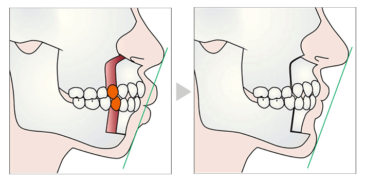 上下セットバック　ワイヤー矯正では得られない治療結果を短期間で