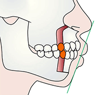 上下顎骨体移動術（口ゴボ、口元全体が前方に突き出ている）