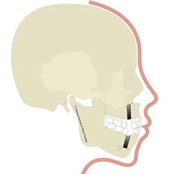 セットバック(上下顎骨体移動術)の施術プロセス1 全身麻酔・手術・入院