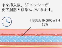 ３Dメッシュが皮下組織と馴染んでいきます