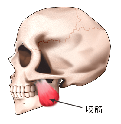 エラが張る原因