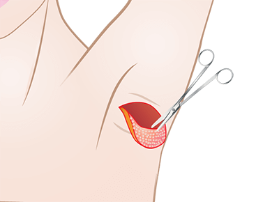 ワキガ治療 反転剪除法の施術プロセス アポクリン腺を除去