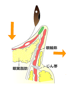 目の下のふくらみみが影になってできる｢黒クマ｣