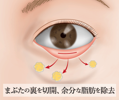 下まぶたたるみ取り（脱脂法）の特徴