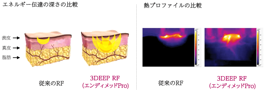 従来のRFとエンディメッドプロの比較