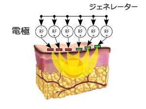 エンディメッド フラクショナルのメカニズム