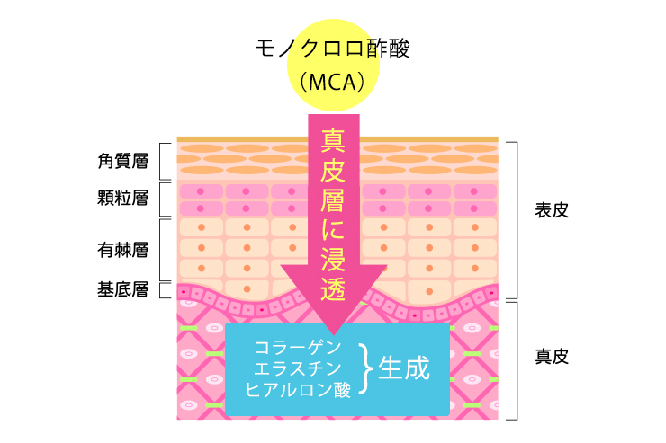 モノクロロ酢酸(MCA)は真皮層に浸透、コラーゲン、エラスチン、ヒアルロン酸を生成します