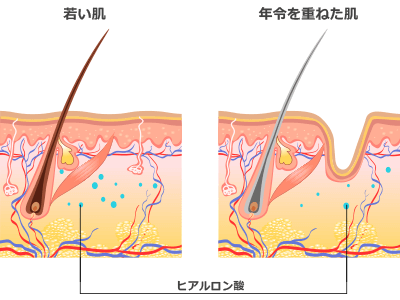 大塚美容形成外科で使用するヒアルロン酸