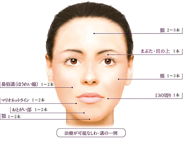 ヒアルロン酸注入量の目安