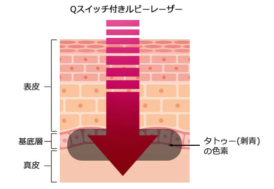 タトゥー（刺青）除去のメカニズム