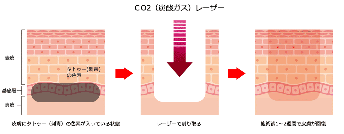 タトゥー（刺青）除去のメカニズム