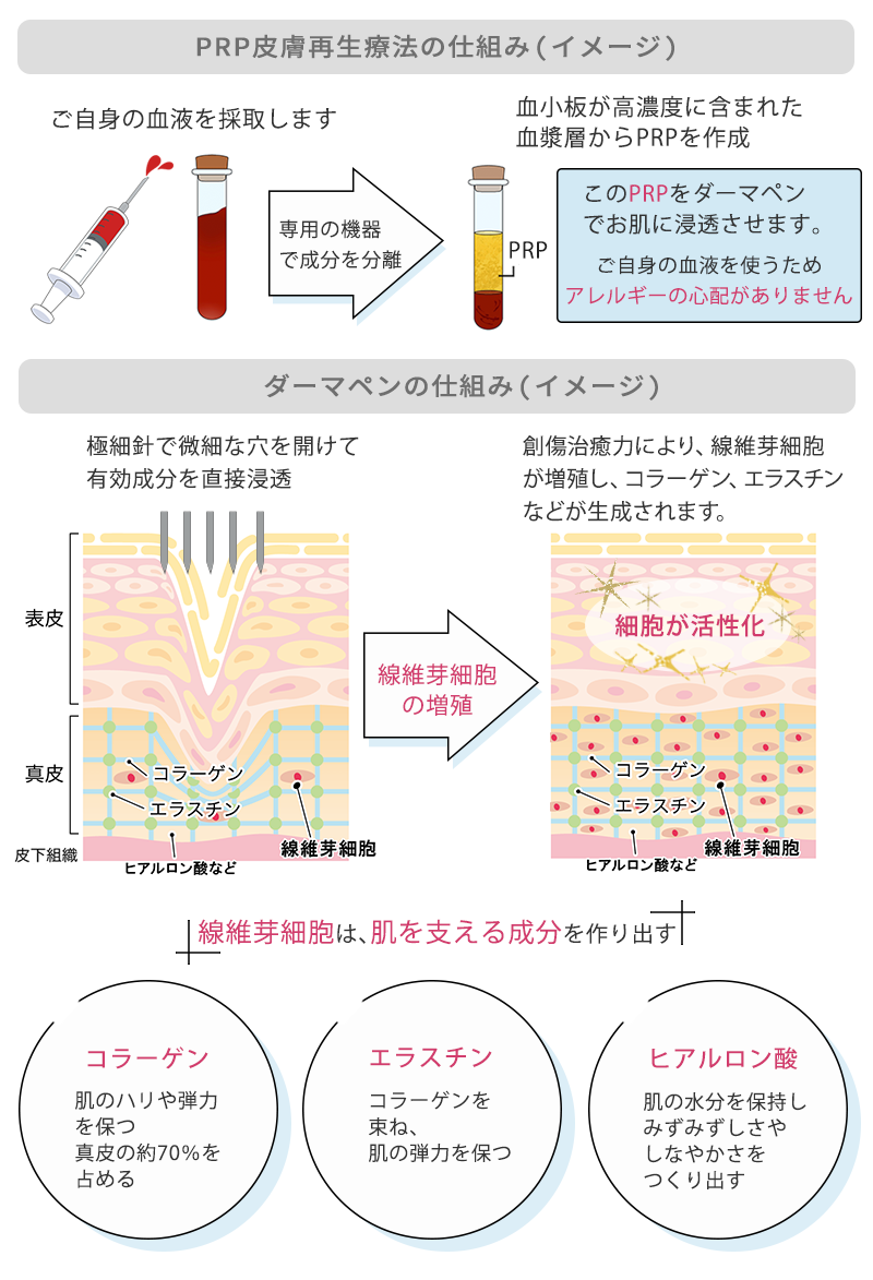 ダーマペンの仕組み（イメージ）