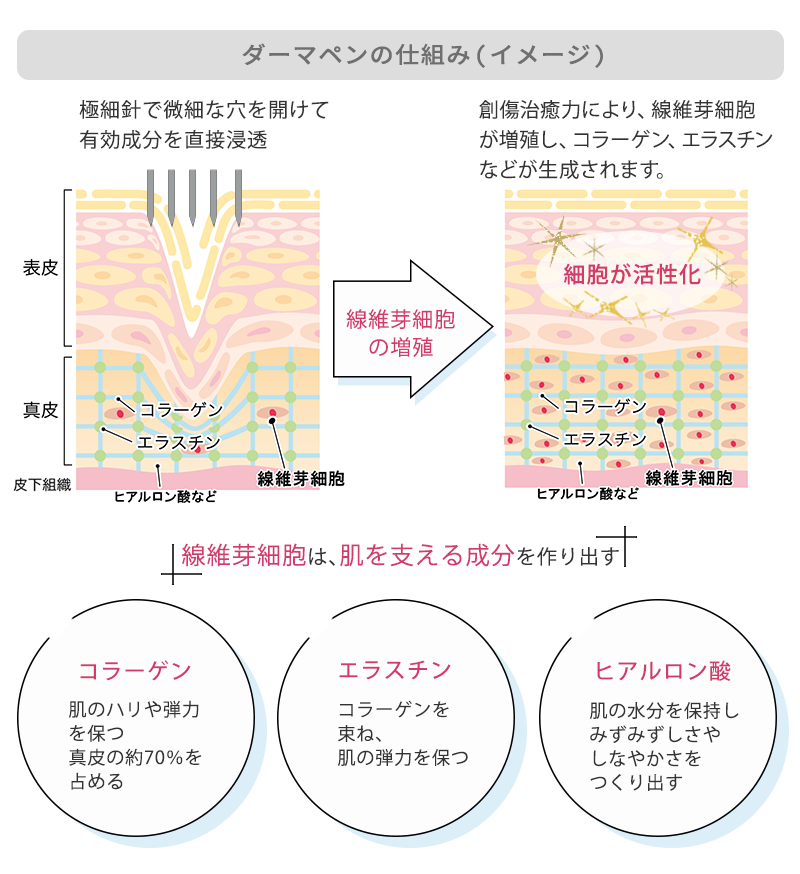 ダーマペンの仕組み（イメージ）