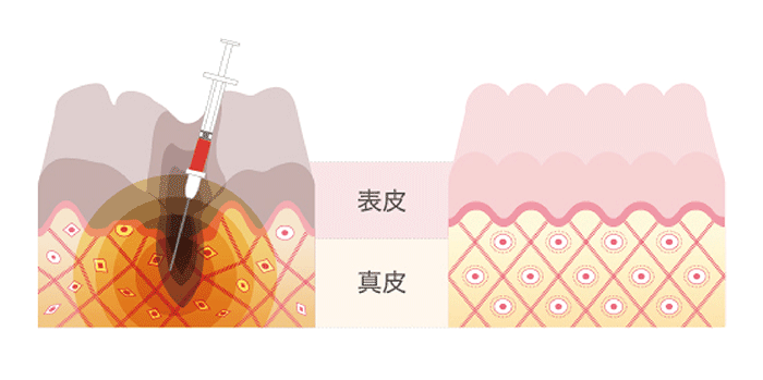 VFD毛髪再生治療（イメージ