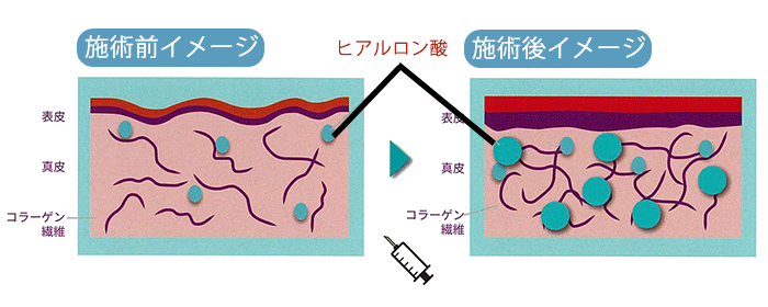 ボライトXC、施術前と施術後のイメージ