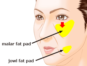 頬・あごのたるみ