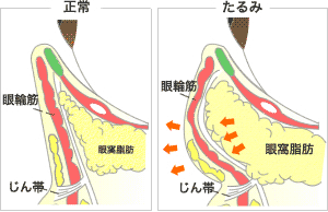 目（下まぶた）のたるみ