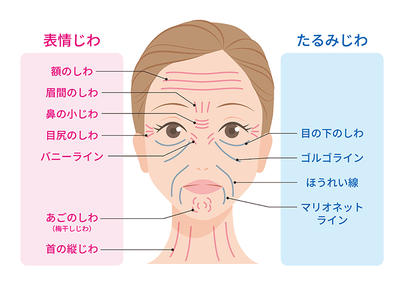 しわの治療について