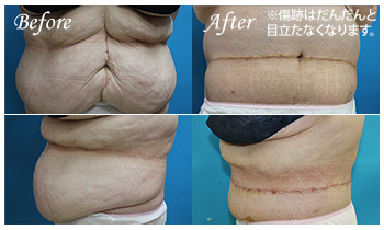皮膚切除・脂肪切除手術の症例写真 before after