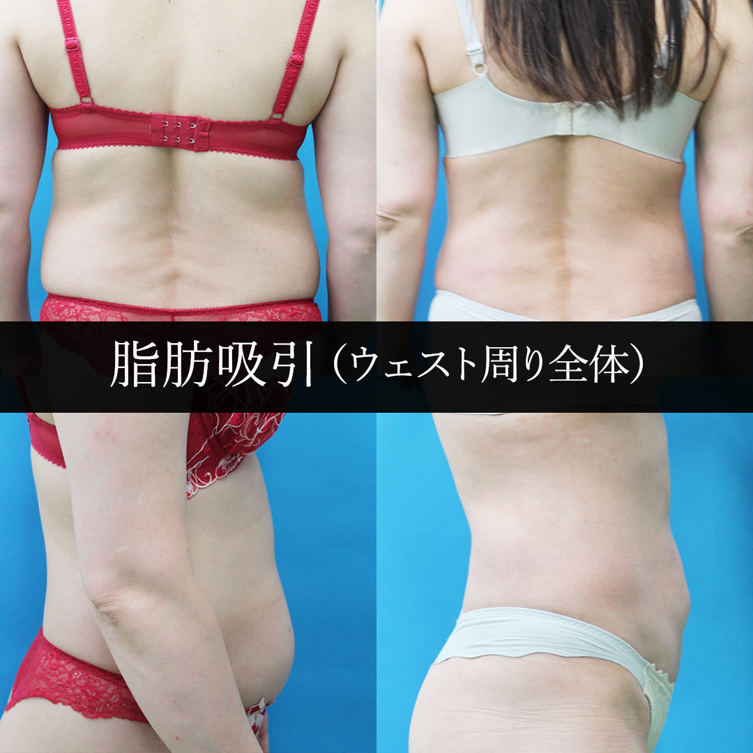 脂肪吸引（ウェスト周り全体）