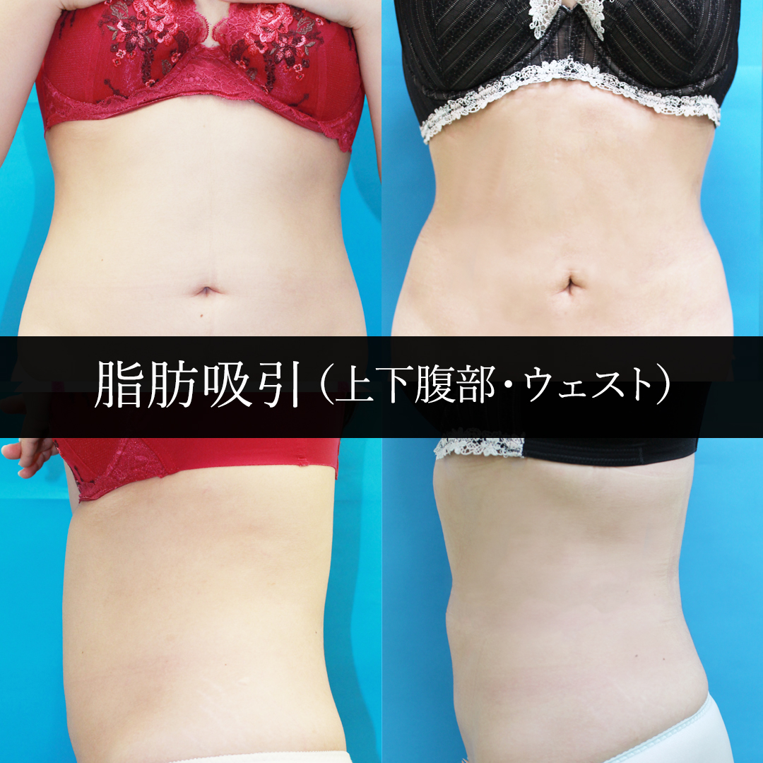 脂肪吸引（上下腹部・ウェスト周り）