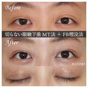 切らない眼瞼下垂 ミューラー筋タッキング法（MT法）手術後 症例写真