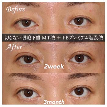切らない眼瞼下垂 ミューラー筋タッキング法（MT法）手術後 症例写真