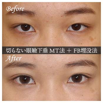 切らない眼瞼下垂 ミューラー筋タッキング法（MT法）手術後 症例写真
