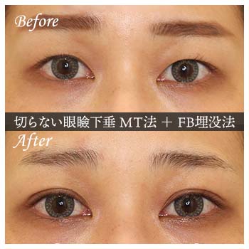 切らない眼瞼下垂 ミューラー筋タッキング法（MT法）手術後 症例写真