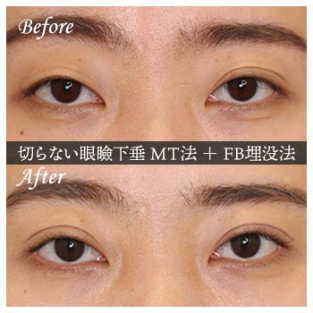 切らない眼瞼下垂 ミューラー筋タッキング法（MT法）手術後 症例写真