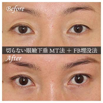 切らない眼瞼下垂 ミューラー筋タッキング法（MT法）手術後 症例写真