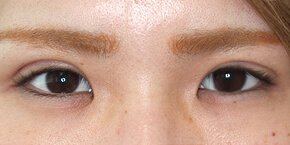 眠たそうな目 眼瞼下垂 の悩みやご相談 大塚美容形成外科 歯科 眠たそうな目 眼瞼下垂 の悩みやご相談 大塚美容形成外科 歯科