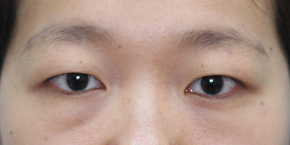小さい目の悩みやご相談 二重整形施術なら大塚美容形成外科 歯科