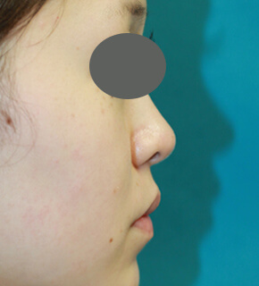 耳介軟骨移植術の症例写真 施術後（5ヶ月後）