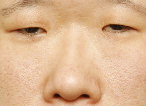 鼻骨骨切り 幅寄せ 鼻の整形なら大塚美容形成外科 歯科