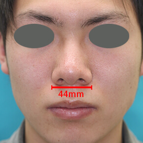 男性の鼻の症例写真 美容整形なら大塚美容形成外科 歯科