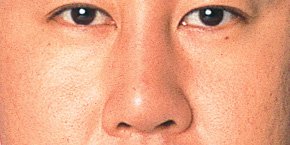 斜鼻修正の症例写真 鼻の整形なら大塚美容形成外科 歯科