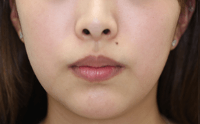 Bnls Neoの症例写真 美容整形なら大塚美容形成外科 歯科