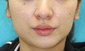 エラボトックス注入の症例写真 美容整形なら大塚美容形成外科 歯科 エラボトックス注入の症例写真 美容整形なら大塚美容形成外科 歯科