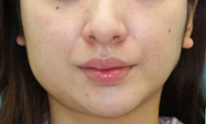 エラボトックス注入の症例写真 美容整形なら大塚美容形成外科 歯科