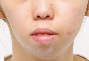 頬注入術 ボリュームアップ 美容整形なら大塚美容形成外科 歯科