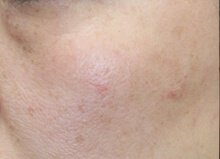 Qスイッチルビーレーザー｜肌の治療やスキンケアなら大塚美容形成外科