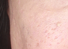 フラクショナルレーザー 施術後