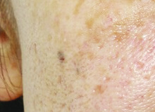 フラクショナルレーザーの症例写真 美容整形なら大塚美容形成外科 歯科 フラクショナルレーザーの症例写真 美容整形なら大塚美容形成外科 歯科
