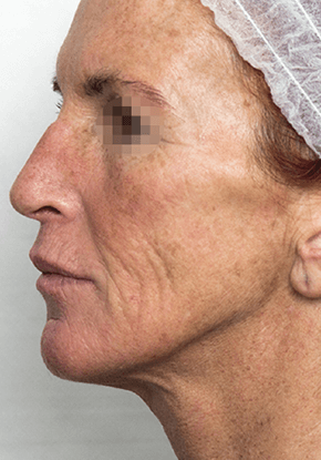 マッサージピール（PRX-T33®）｜肌の治療やスキンケアなら大塚美容形成外科