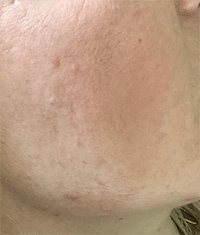 マッサージピール 施術後