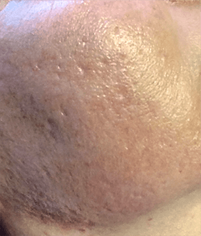 マッサージピール 施術前