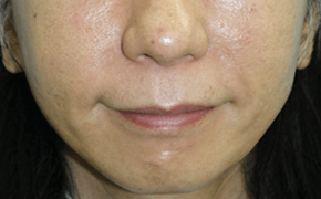 ヒアルロン酸注入 施術後