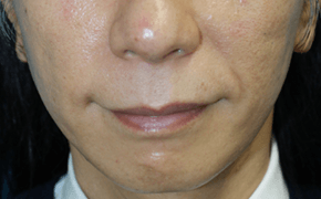 ヒアルロン酸注入 施術前