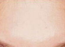 トレチノイン治療 施術後